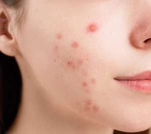 Acne sul viso giovanile di una donna