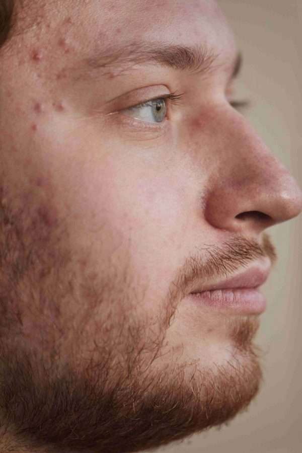 Acne sul viso di un uomo