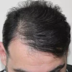 capelli dopo Folisin