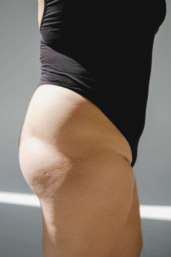 Cellulite sulla coscia