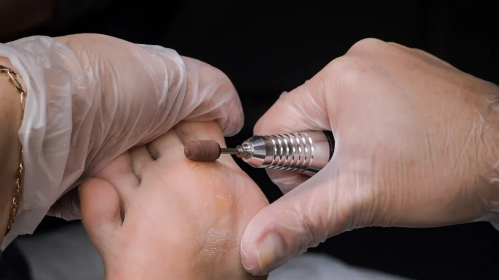 intervento sul piede