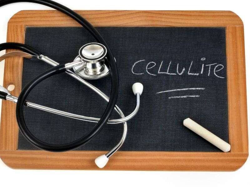 sconfiggere la cellulite