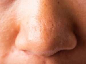 inestetismi del naso