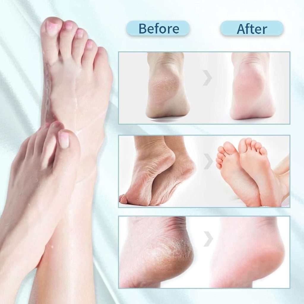 prima e dopo il trattamento con la maschera piedi idratante Footea
